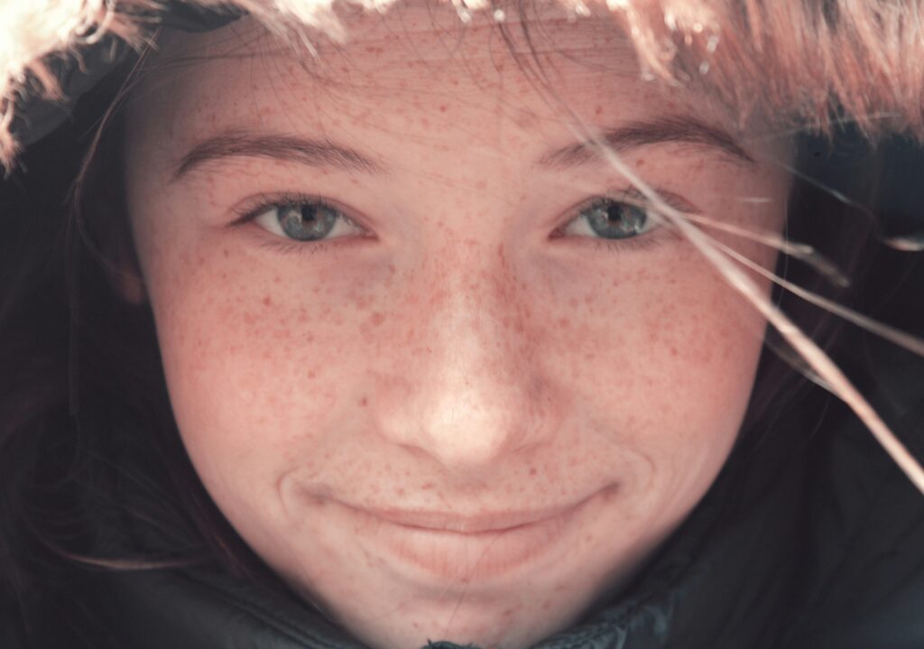 teen girl without acne scarring because of polynucleotides
